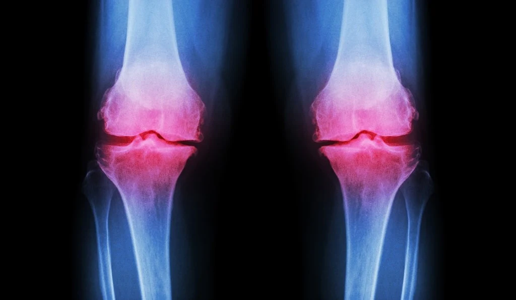Orthokin: Effektive Therapie bei Arthrose