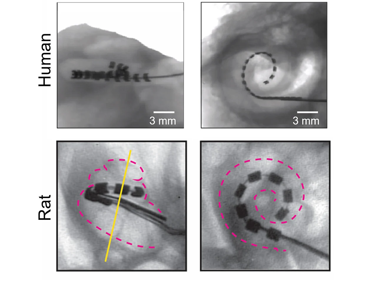 Hirnflexibilität erhöht Wirksamkeit von Cochlea-Implantaten