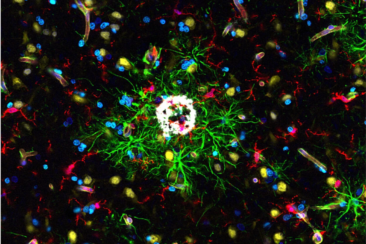 Neue Zellpopulation im Alzheimer-Gehirn entdeckt