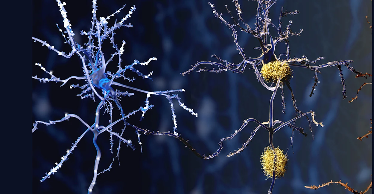 Antikörper-Therapien: Kein klinischer Nutzen gegen Alzheimer