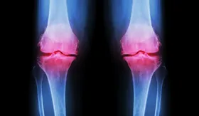 Orthokin: Effektive Therapie bei Arthrose
