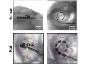 Hirnflexibilität erhöht Wirksamkeit von Cochlea-Implantaten
