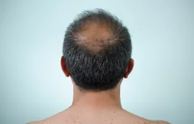 Neue Genvarianten für Haarausfall bei Männern entdeckt