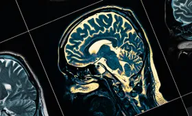 Seltene Mutation schützt vor Alzheimer