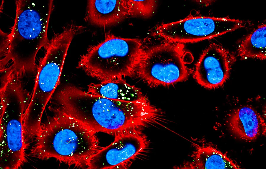 Melanomzellen mit rot gefärbten Zellmembranproteinen CD44 und blau gefärbten Zellkernen. Dazwischen grün gefärbte extrazelluläre Vesikel