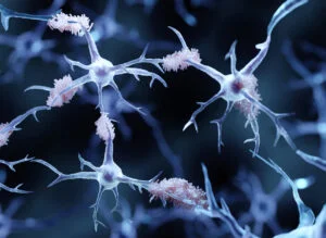 Amyloid-Klumpen im Gehirn