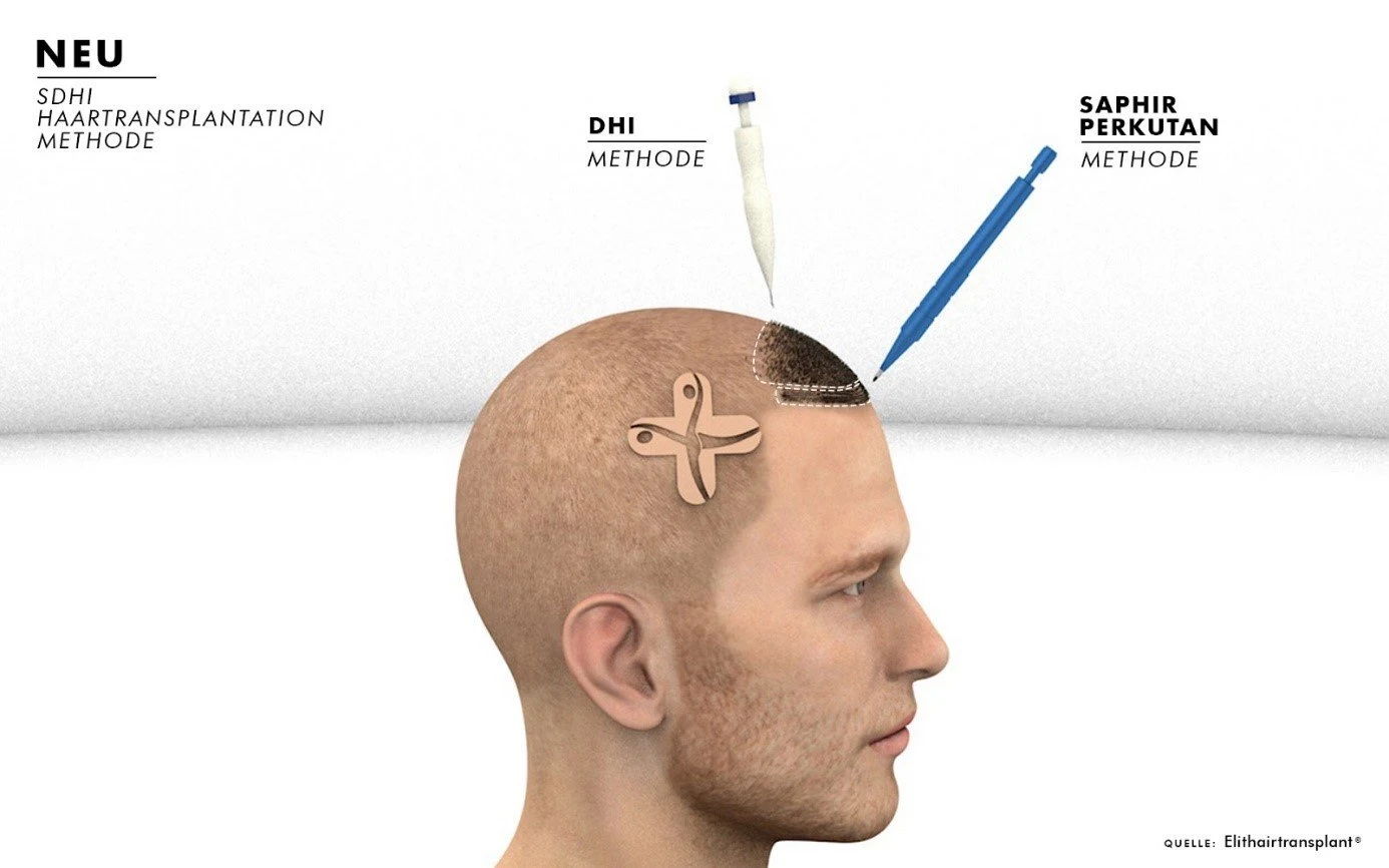 Haartransplantationen in Istanbul: Methoden mit hoher Erfolgsquote