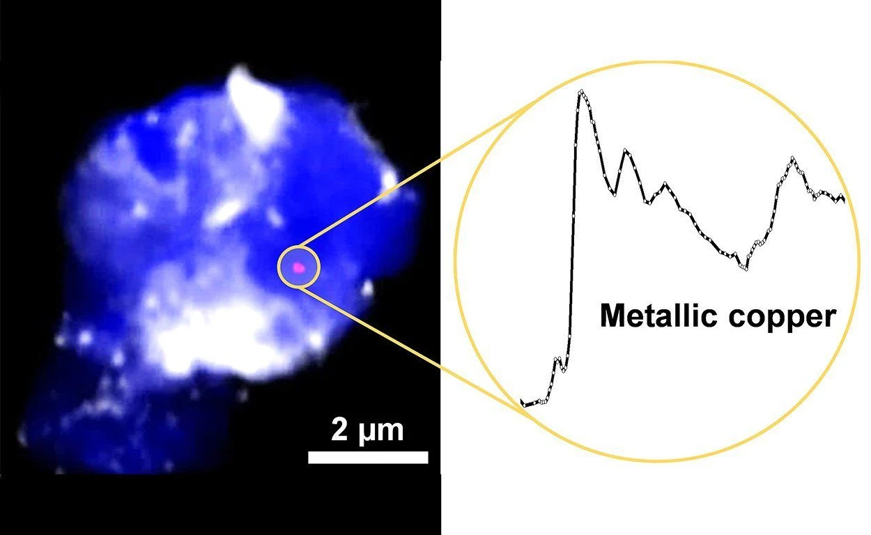Metalle im Gehirn von Alzheimer-Patienten entdeckt