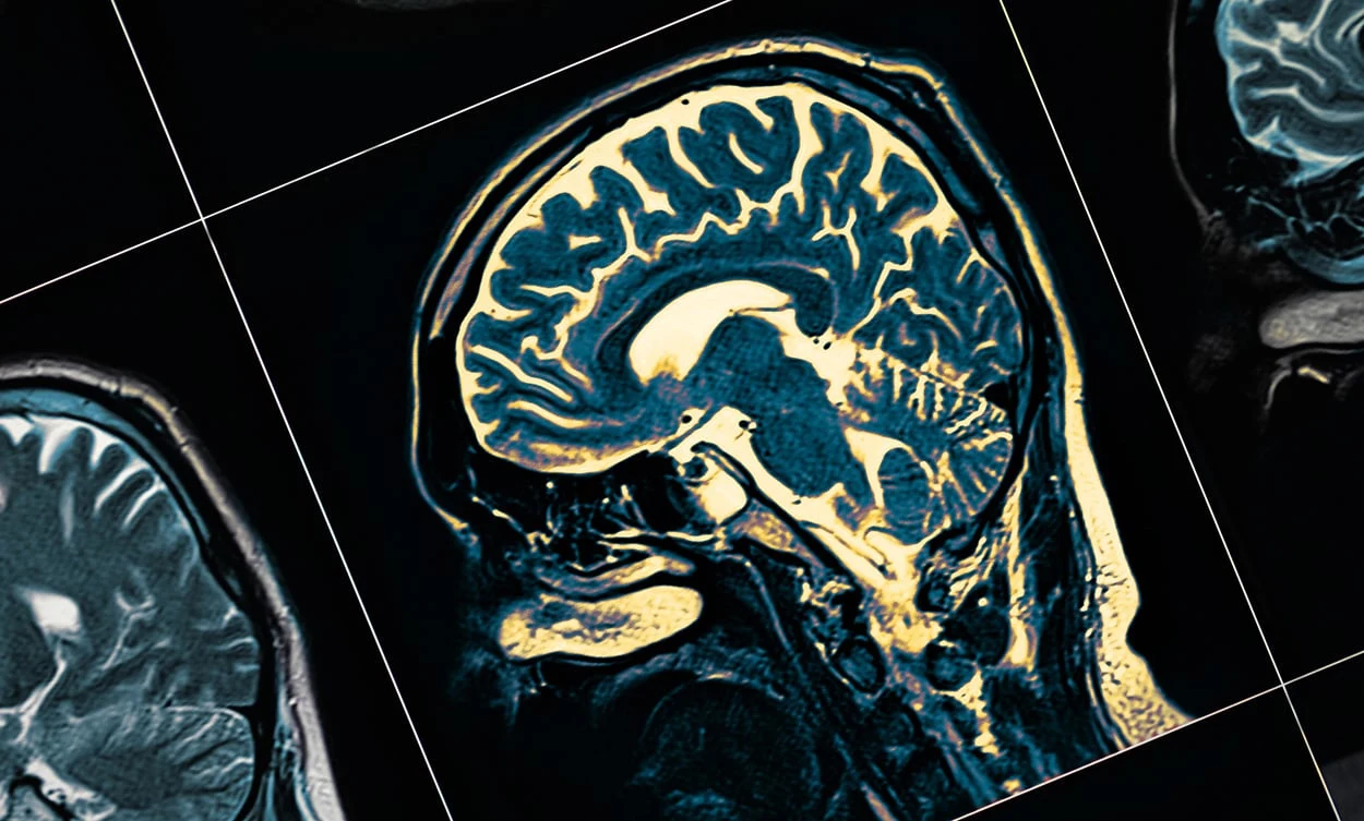 Seltene Mutation schützt vor Alzheimer