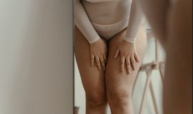 Lipödem: Warum die chronische Fettverteilungsstörung fast nur Frauen betrifft